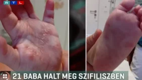 Surge in congenital syphilis cases in Hungary: 21 infant deaths this year